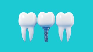 dental implant illustration