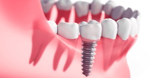 Dental Implants