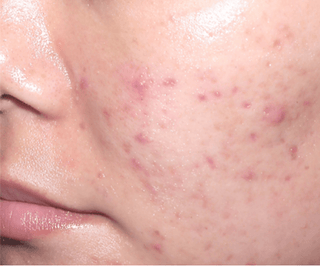 Skin wit Acne