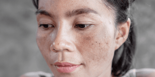 Skin with melasma