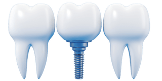 Dental Implants