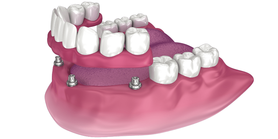 3D model of a full arch denture supported by multiple dental implants
