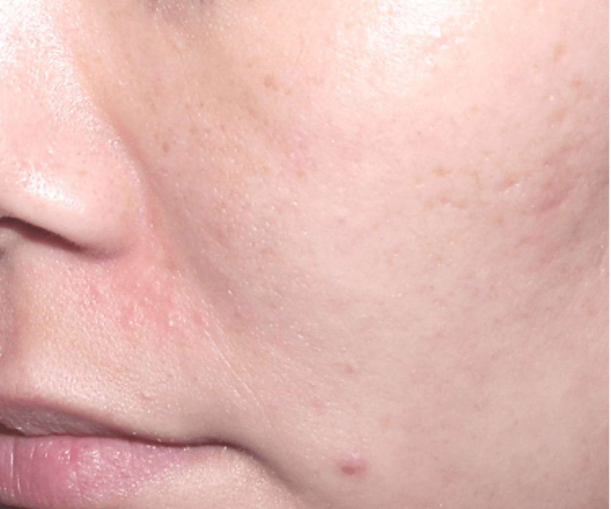 Close-up of cheek with reduced acne and smoother skin appearance