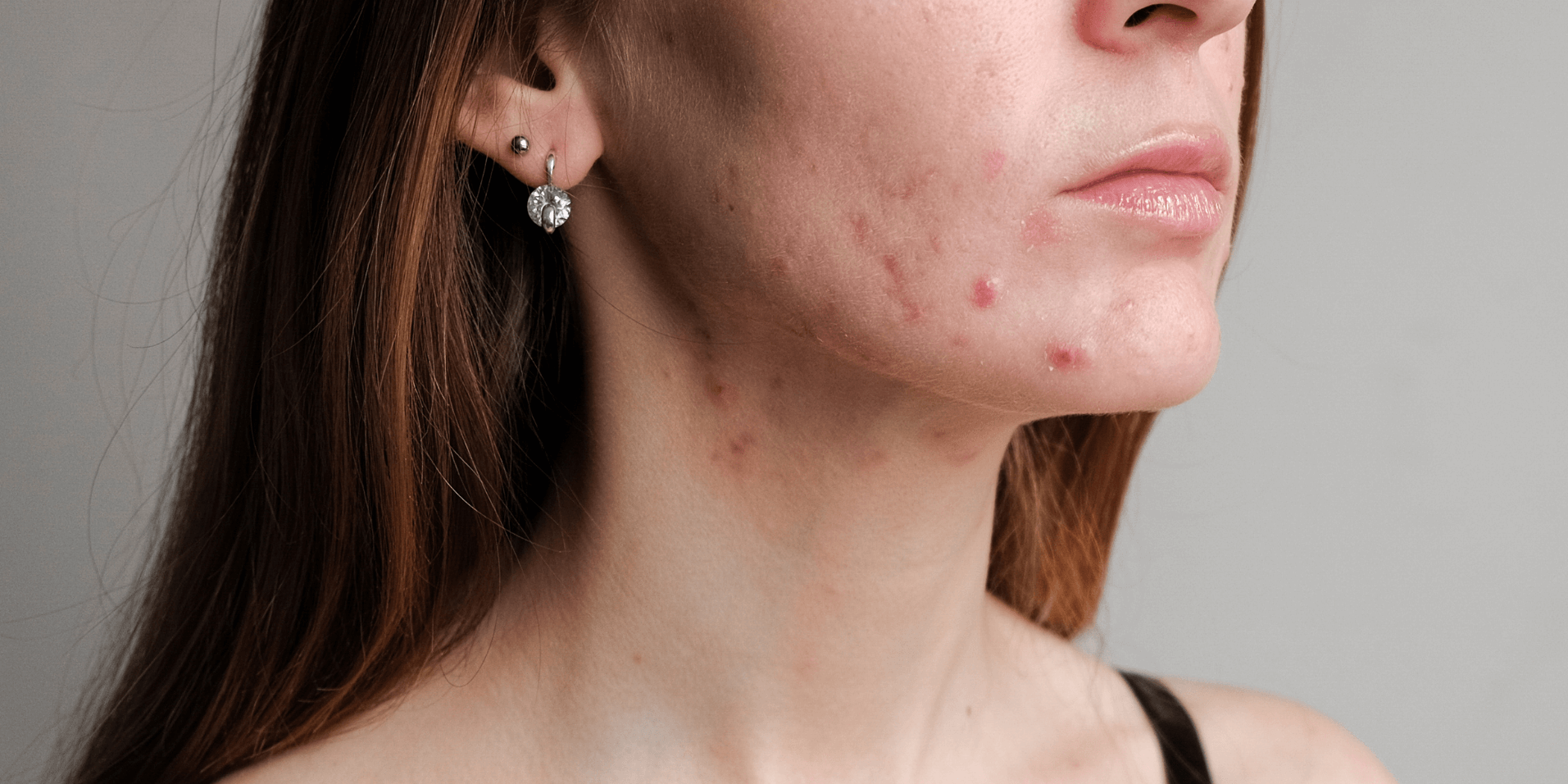 Acne breakouts along the jawline and neck area