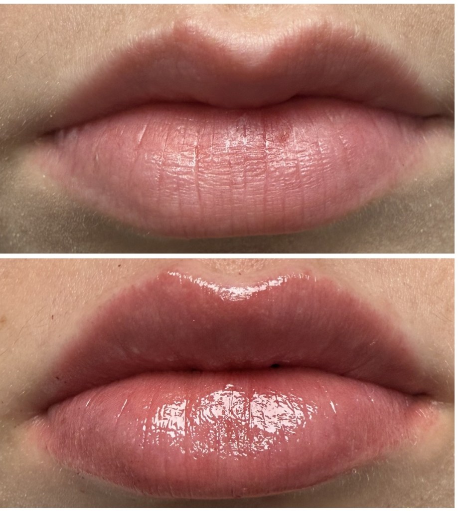 Front view before and after lip filler showing improved lip fullness and symmetry.