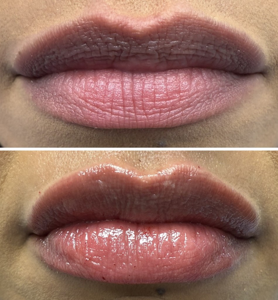 Before and after lip filler side profile showing increased volume and improved lip contour.