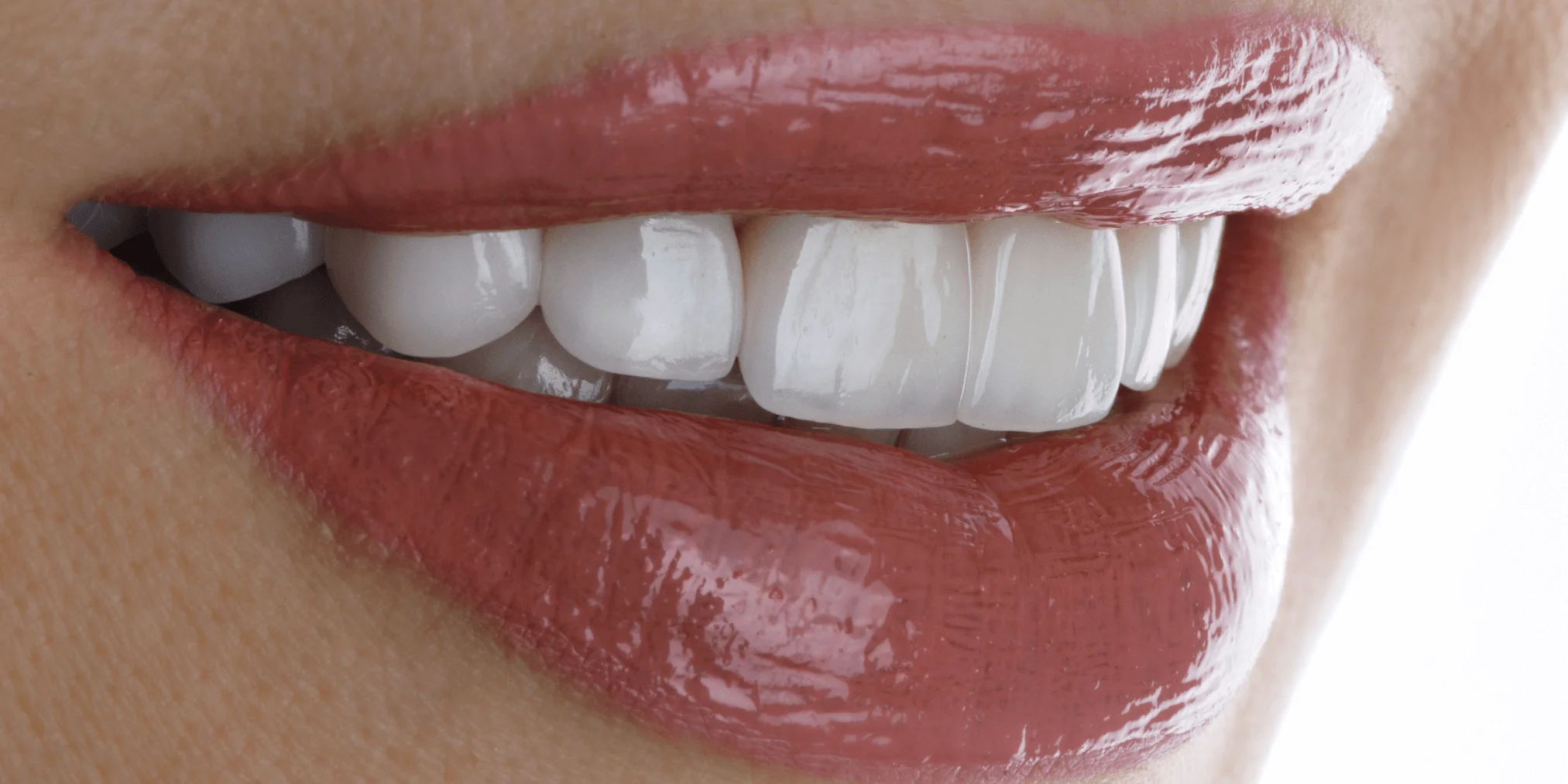 Close-up of a natural-looking porcelain veneers smile, performed at Envy Dental in Wichita, KS