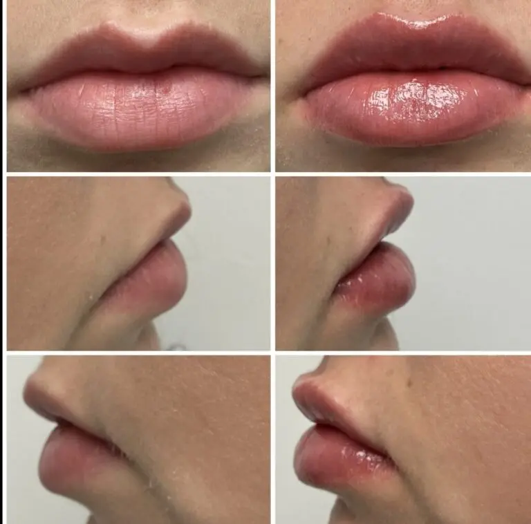 Before and after lip filler treatment showing enhanced lip volume, symmetry, and definition.