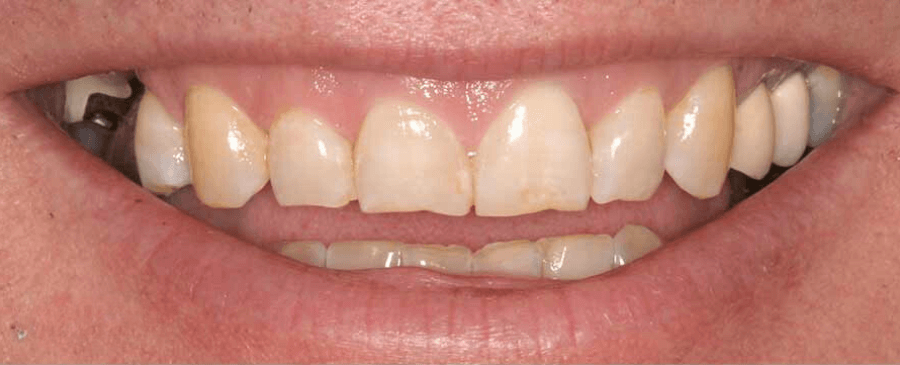 Patient smile before cosmetic dentistry treatment showing natural tooth condition.