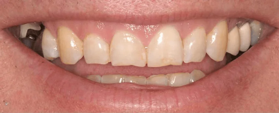 Patient smile before cosmetic dentistry treatment showing natural tooth condition.