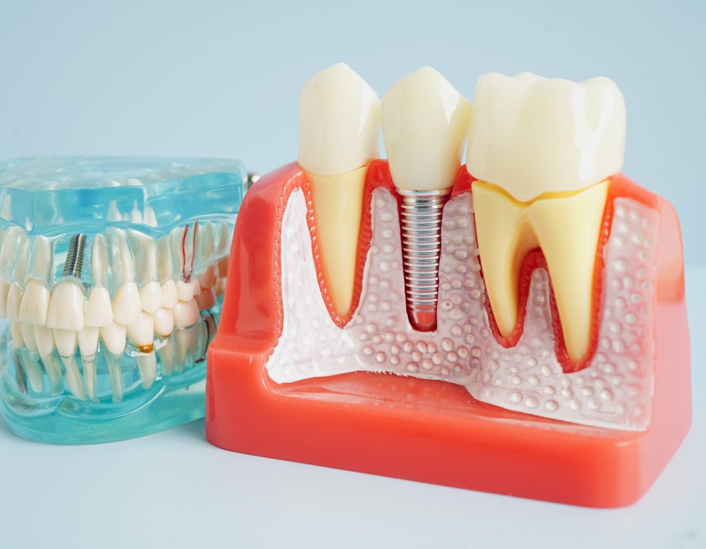 Single Dental Implant