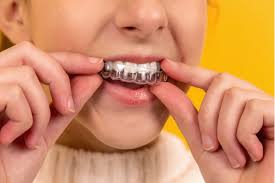 Clear aligners teeth straightening