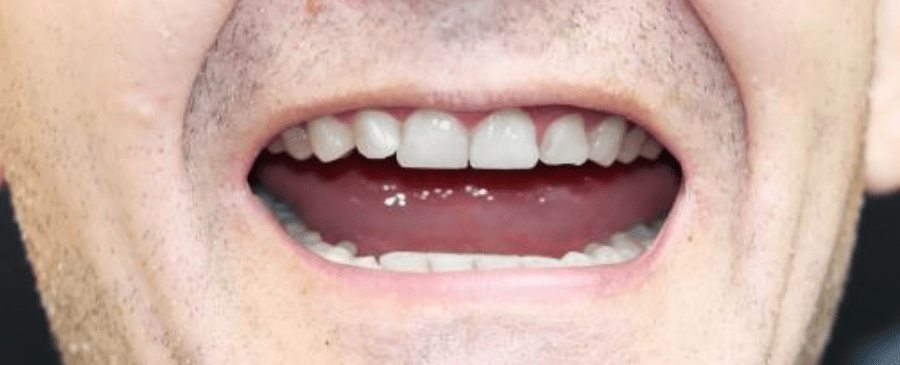after all 4 dentures