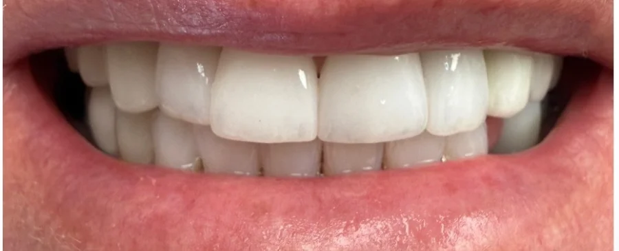 Patient smile after cosmetic dentistry treatment showing improved tooth appearance.