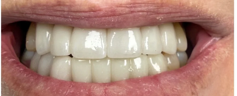 Patient smile after cosmetic dentistry treatment showing improved tooth appearance.