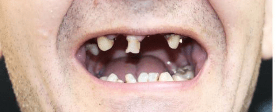 dentures before