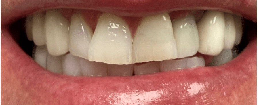 Patient smile before cosmetic dentistry treatment showing natural tooth condition.