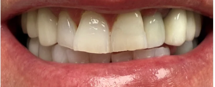 Patient smile before cosmetic dentistry treatment showing natural tooth condition.