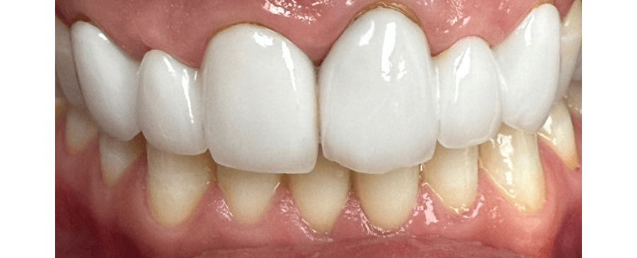Patient smile before cosmetic dentistry treatment showing natural tooth condition.