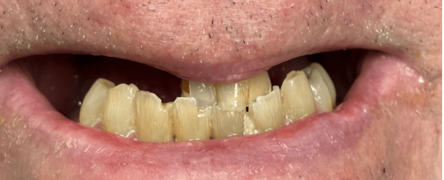 Patient smile before cosmetic dentistry treatment showing natural tooth condition.