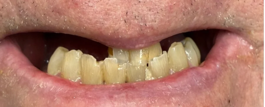 Patient smile before cosmetic dentistry treatment showing natural tooth condition.