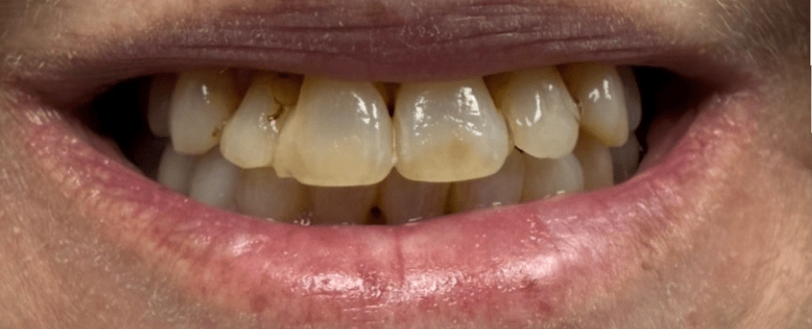 Patient smile before cosmetic dentistry treatment showing natural tooth condition.